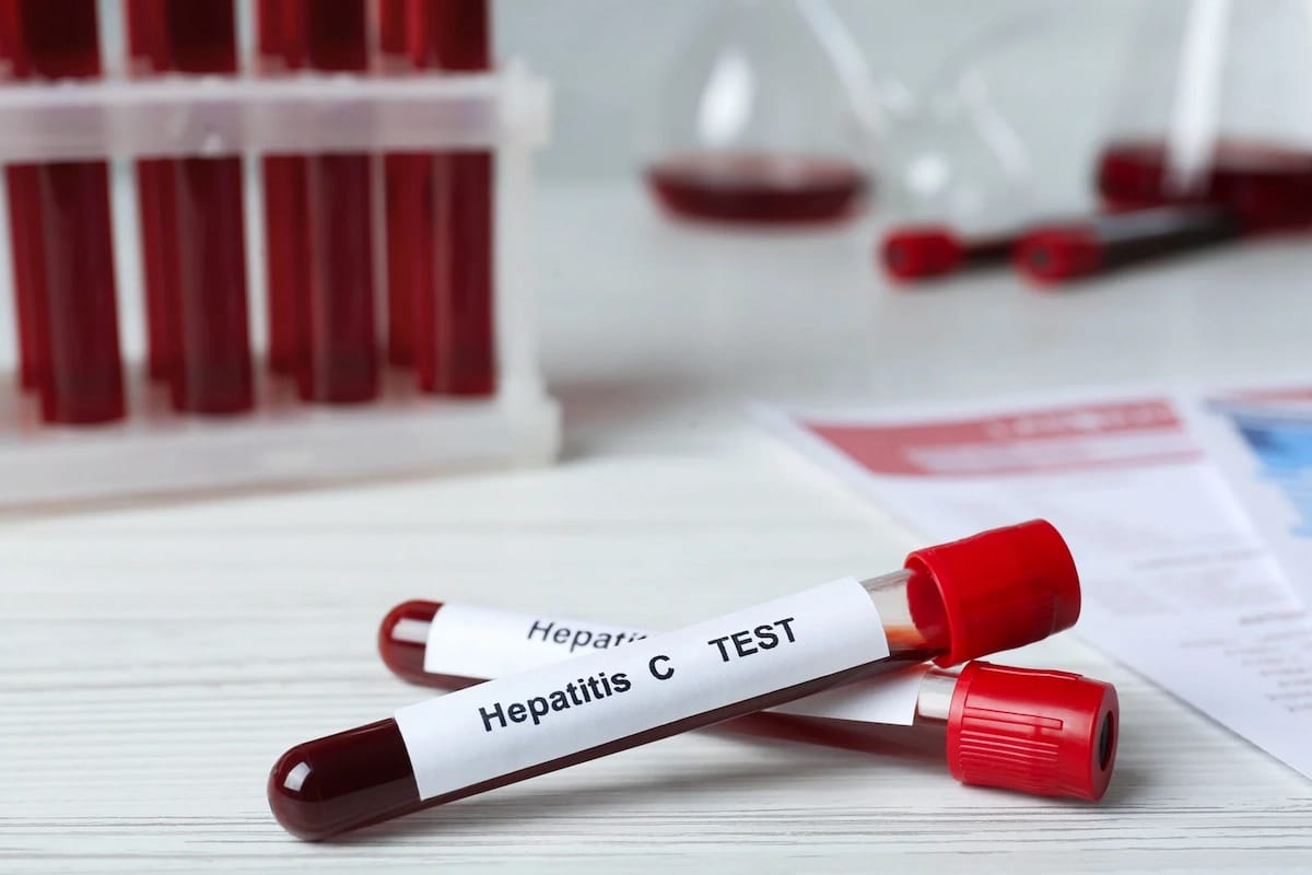 Hepatitis, Fatty Liver & Cirrhosis